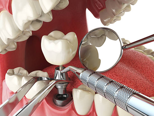 Emergency Dental Filling Replacement in MO